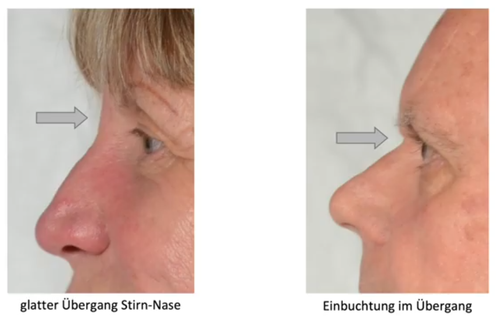 Nasenwurzel Face Reading